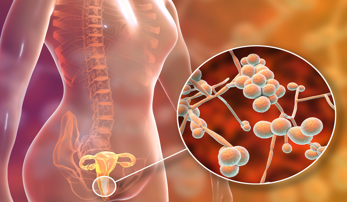 Candida spp. και Γυναικολογική Υγεία: Αντιμετώπιση της Κολπικής Μυκητίασης